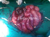 intestinal gangrenei
