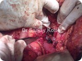 shunt surgery for portal HTv