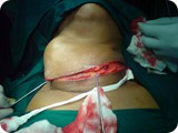 thyroid surgeryab