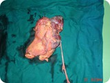 kidney tumor lapa