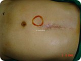 lap incisional herniad