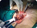 femoral hernia 1a