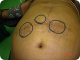 incisional hernia lap repair 2e