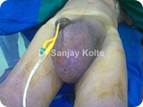 inguinoscrotal herniah